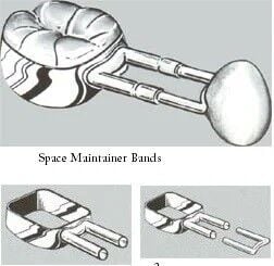Space Maintainer Bands - DSC
