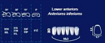 Lower Anterior Acrylic Resin Teeth #3D - NewTek
